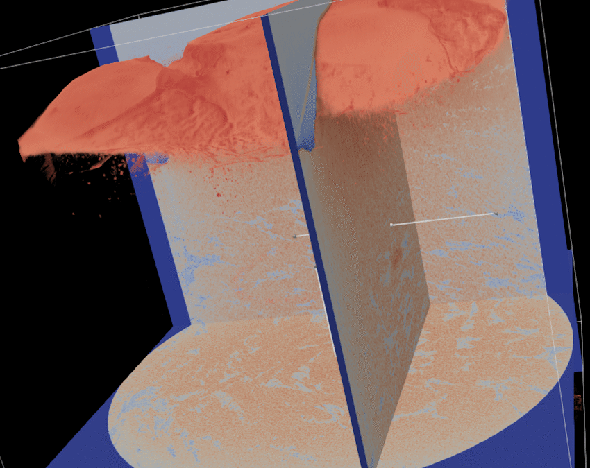 3D investigation of oral cancer invasion patterns using synchrotron X-ray phase contrast imaging